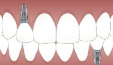 implant dentar in Bucuresti