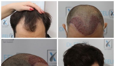 dr felix hair implant
